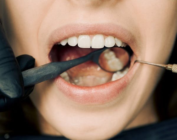 Traitement des caries dentaires : solutions modernes et efficaces